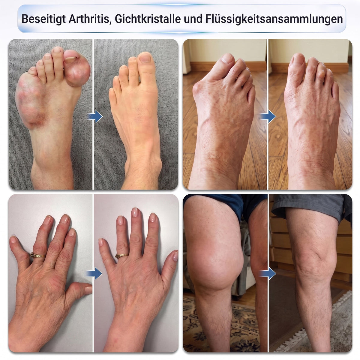𝑿𝑹𝑳𝑿𝑹𝑳® 0,05 mm Mikronadel-Roller zur Unterstützung von Knochen & Gelenken 🧑‍⚕️🧑‍⚕️  (Für alle Erwachsenen, Frauen & Männer – Umfassende Pflege bei verschiedenen Gelenkbeschwerden)